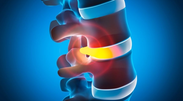 Τι είναι η απονεύρωση με χρήση ραδιοσυχνοτήτων