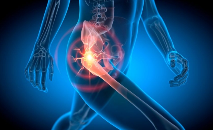 Οστεοαρθρίτιδα ισχίου