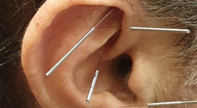 Βελονισμός